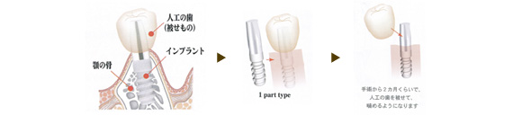 インプラント手順