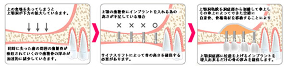 サイナスリフト