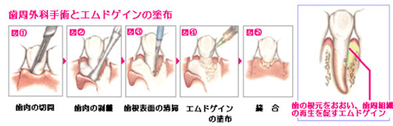 エムドゲイン法