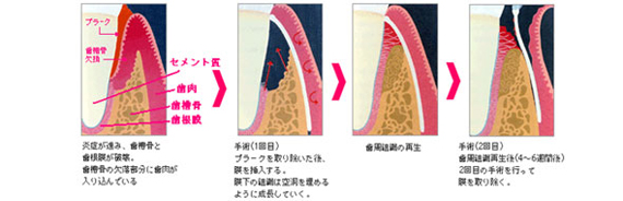 GTR法